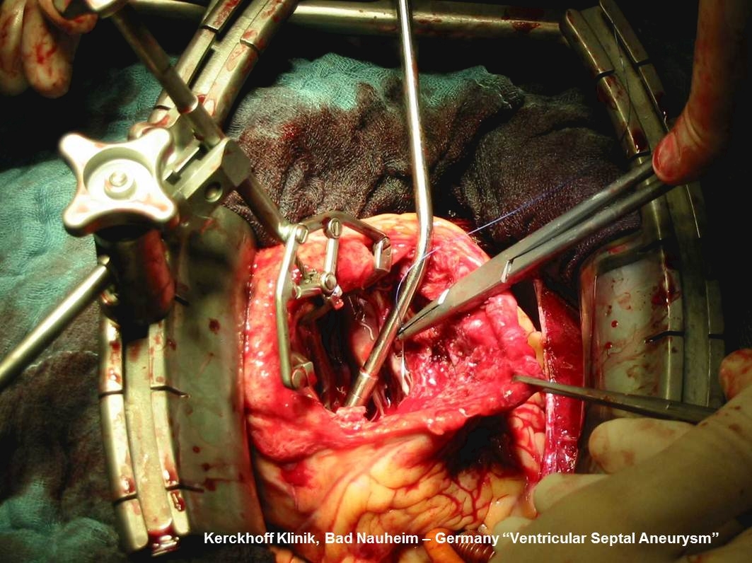 Self Photos / Files - Cor-Valv Surgical Set up - Inter-Ventricular Defect