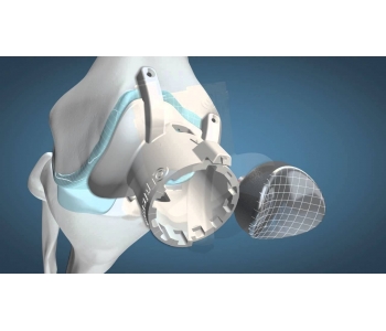 Episealer Knee Implant 2