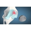 Episealer Knee Implant 1