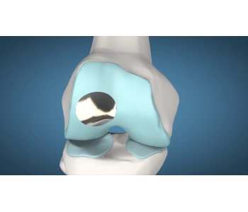 Episealer Knee Implant 3