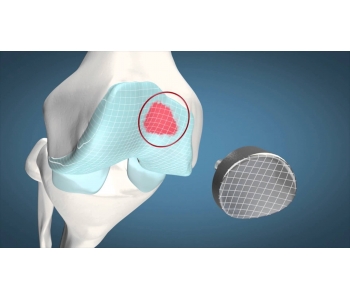 Episealer Knee Implant 1