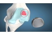 Episealer Knee Implant 1